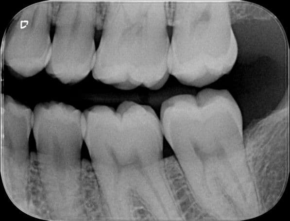 Dental X-ray showing root canal at Vere Dental