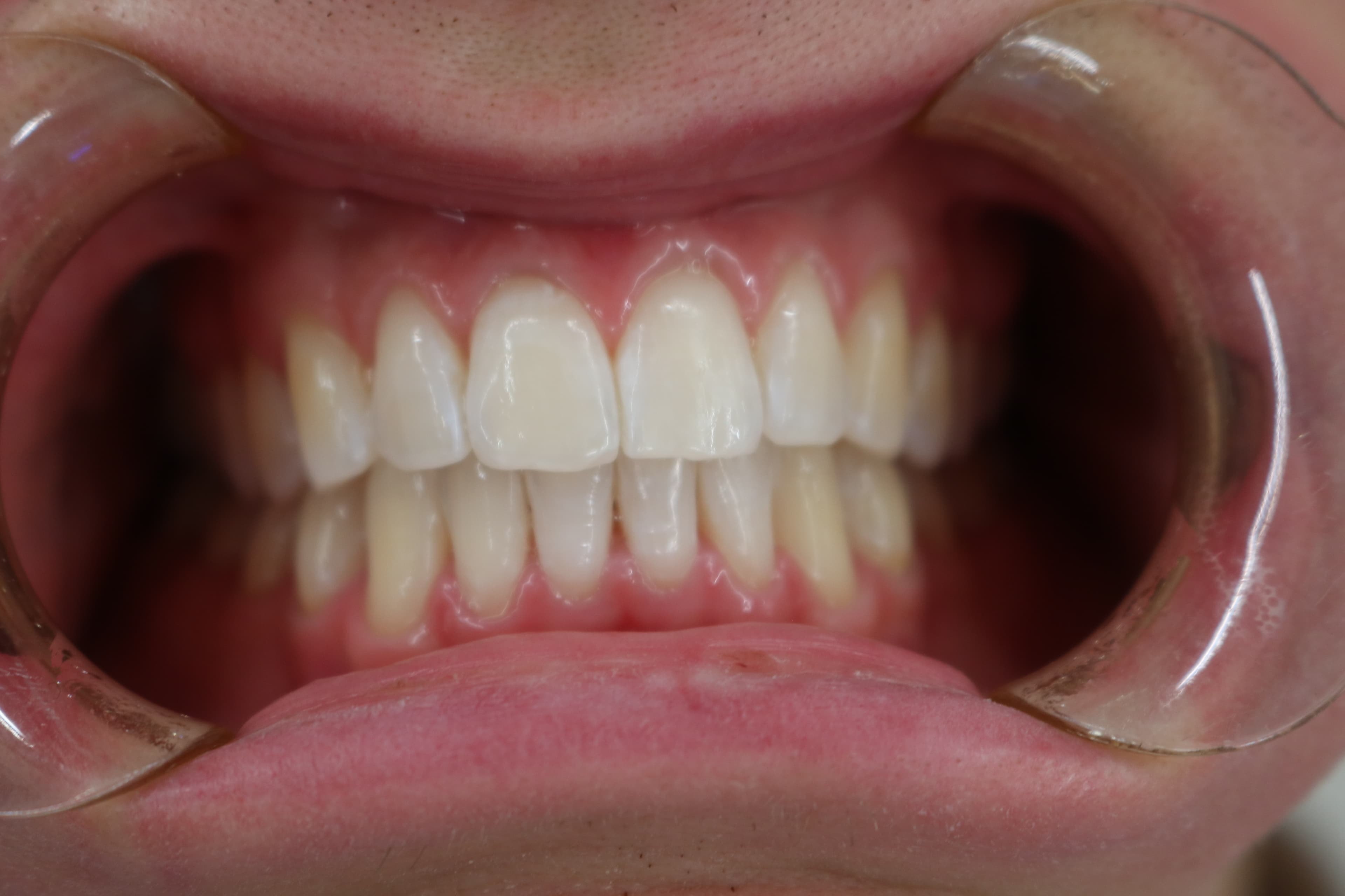 Clear aligner result at Vere Dental