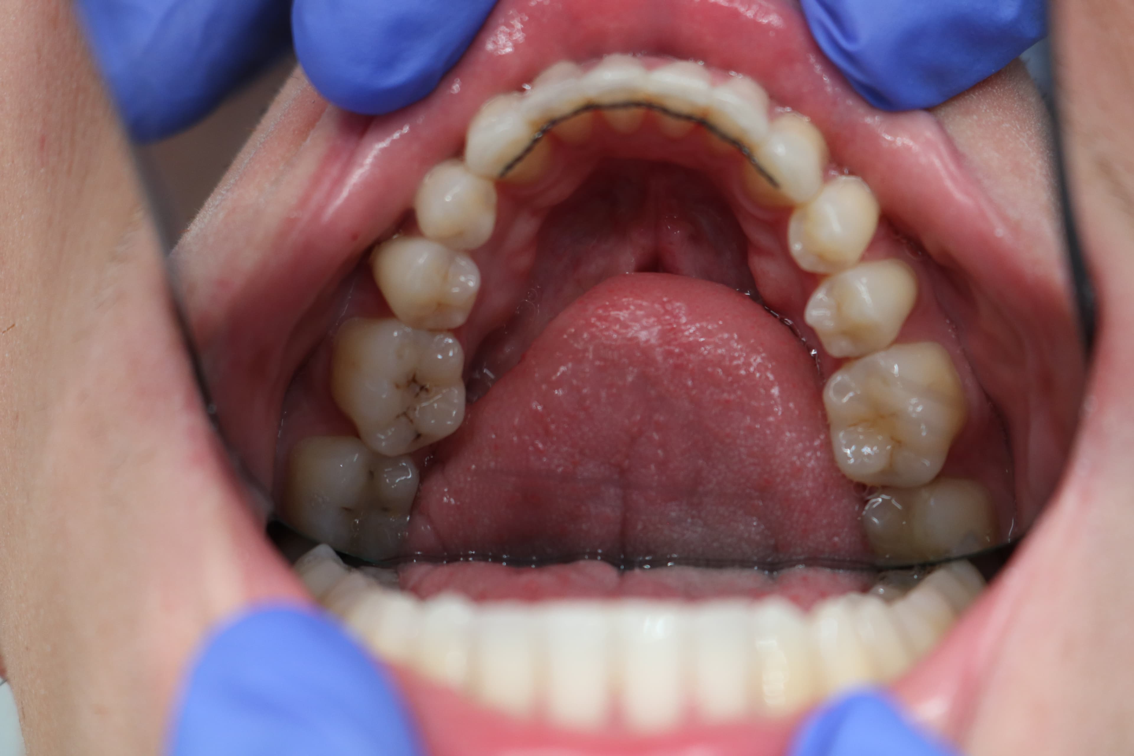 Clear aligner retainer fitting