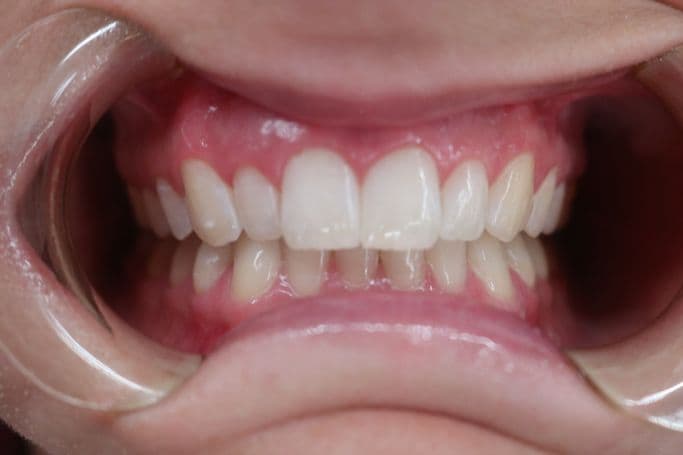 Healthy dentition following examination at Vere Dental
