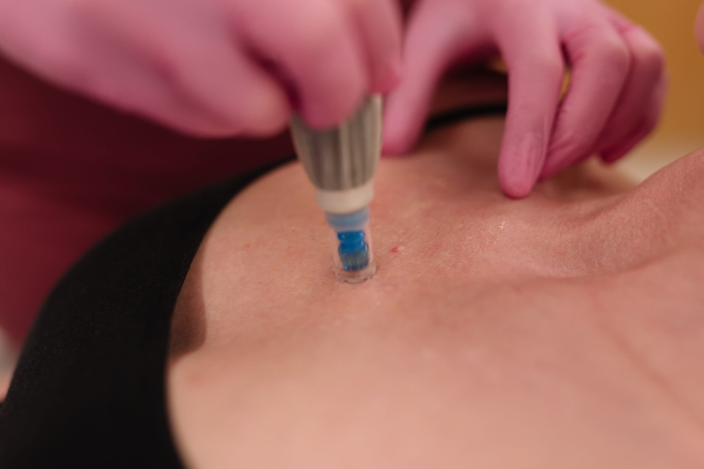 Profhilo treatment at Vere Dental